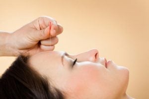 Akupunktur, baş ağrılarını hafifletmeye yardımcı olabilecek alternatif bir terapidir.