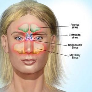 sinus enfeksiyonu nedir