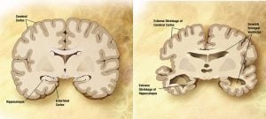 Normal bir yaşlı beynin (sol) ve bir kişinin beyninin Alzheimer'le (sağda) karşılaştırılması. İkisini ayıran özellikleri dikkat çekiyor.