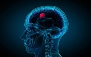 Beyin Tümörü nedir-belirtileri-tenedi-tanı ve tedavisi