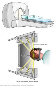 Gamma Knife stereotaktik radyocerrahi teknolojisi, hedefe kesin bir radyasyon dozu vermek için birçok küçük gama ışını kullanır.