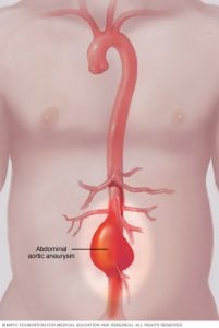 aortik anevrizması, vücudunuzun ana arterinin (aortası) alt kısmı zayıfladığında ve çıkıntı yaptığında ortaya çıkar.