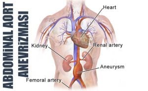 abdominal aort anevrizması