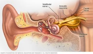 Bir akustik nöroma (schwannoma) denge merkezinde gelişen benign bir tümördür ve iç kulağınızdan beyne giden sinirleri işitir. Bu sinirler, vestibülokoklear siniri (sekizinci kafa siniri) oluşturmak için birlikte katlanırlar. Tümörün sinir üzerindeki baskısı işitme kaybına ve dengesizliğe neden olabilir.