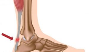 aşil tendonu nerededir