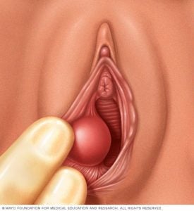 Bartholin bezleri, vajinal deliğin her iki yanında bulunur. Vajinayı yağlamaya yardımcı olan sıvı salgılarlar. Bazen bu bezlerin kanalları tıkanmış ve sıvı geri yükleyerek bir kist oluşturmuştur.