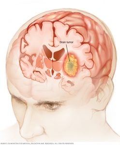Beyin hücrelerinde (gösterildiği gibi) beyin tümörü oluşabilir veya başka yerden başlayıp beyne yayılabilir. Tümör büyüdükçe, baş ağrısı, mide bulantısı ve denge problemleri gibi bulgu ve belirtilere neden olan çevresindeki beyin dokularına baskı yapar ve bunları değiştirir.