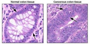 kanser patoloji ve histolojisi