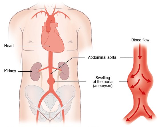 Aort ve şişkin damar duvarı (anevrizma)