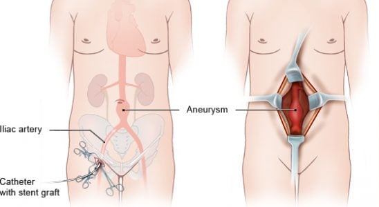 Abdominal aort anevrizması için cerrahi teknikler