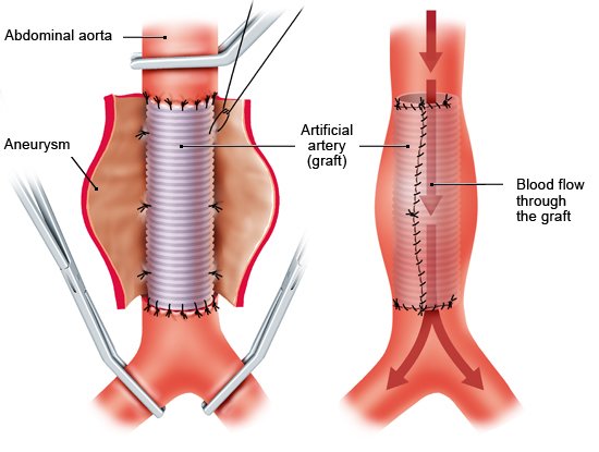 Açık cerrahi: Anevrizma yapay bir damar (greft) ile değiştirilir