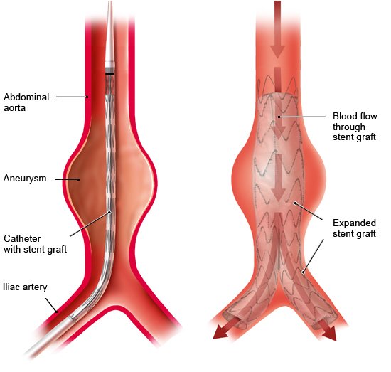 Stent greft ile endovasküler cerrahi