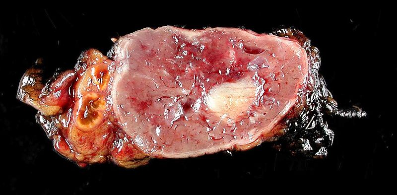 Şekil 3 - Medullada bulunan bir feokromositoma içeren adrenal bez.