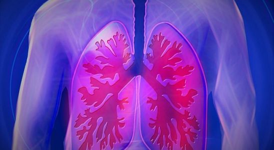 Akciğer-Bronşit