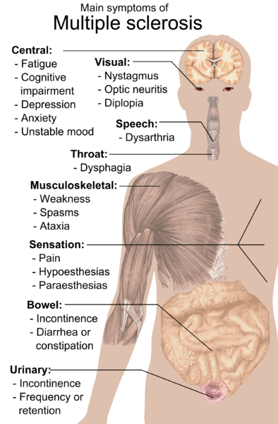 Multipl Skleroz Semptomları