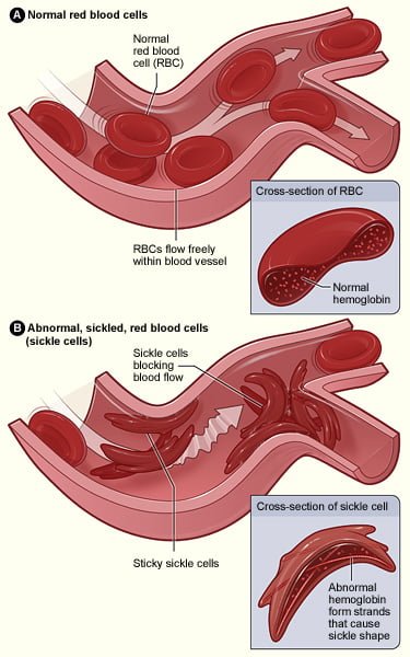 Şekil 3.0 - Normal kırmızı kan hücreleri ile orak hücre hastalığından etkilenenler arasındaki yapı farkı.