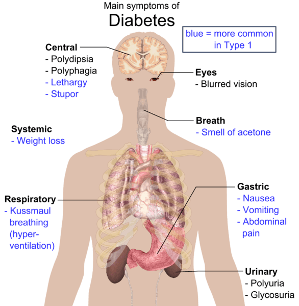 Şekil 2 - Diyabetes mellitusun en sık görülen semptomlarını gösteren diyagram. Mavi yazılı semptomlar, Tip 1 Diyabet ile daha sık ilişkilidir.