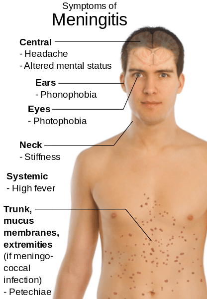 Şekil 3 - Menenjitin tipik semptomları.