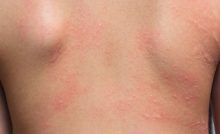 Alerjik Kontakt Dermatit