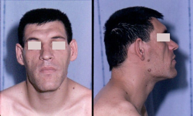 Şekil 3 - Akromegalili bir hastanın yüz özellikleri