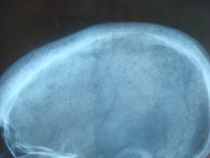 Şekil 3 - Hiperparatiroidizmde sıklıkla görülen 'Tuz ve Biber' işaretini gösteren X-Ray. Artmış kemik rezorpsiyonunun yol açtığı, iyi tanımlanmış çoklu lucivitelerden oluşur.