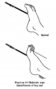 Şekil 3 - Babinski'nin pozitif ve negatif bulguları