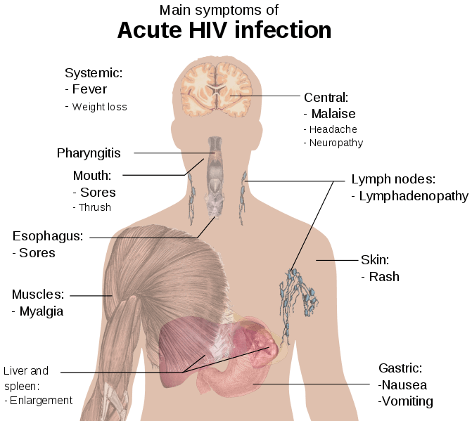 Şekil 3 - HIV enfeksiyonunun semptomlarını özetleyen diyagram.