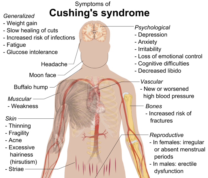 Şekil 4 - Cushing sendromunun semptomlarını gösteren diyagram.